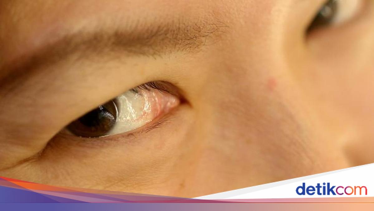 Area Mata Mulai Keriput? Ini 7 Makanan untuk Cegah Penuaan Dini!